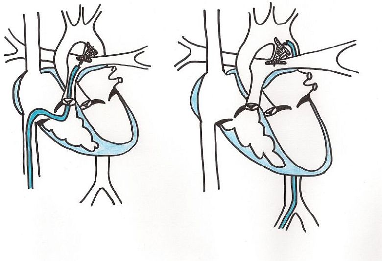 Schématické znázornenie uzáveru perzistujúceho arteriálneho duktu
